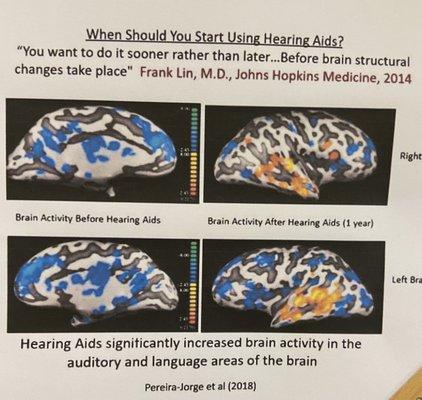 Brain activity with and without hearing.