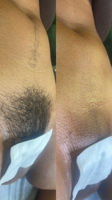 Before & After Brazilian Wax