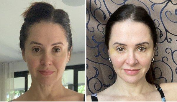 Left: before. Right: after. (6 days after treatment.) Dr. Smith used Bellafill to fill my under eyes and hollowed-out temples. Very pleased!