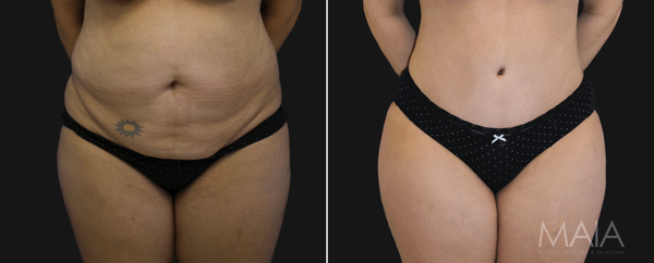 Before and After: Patient's Tummy Tuck, Lipo, and Breast Implant Removal & Lift with Dr. Maia in Tysons Corner, VA