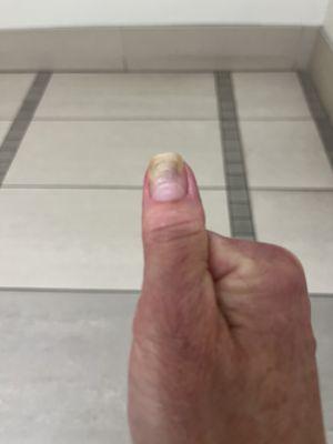 This is my nail in July 2024, improving with treatment and no longer painful but still very ugly. Think twice about going here.