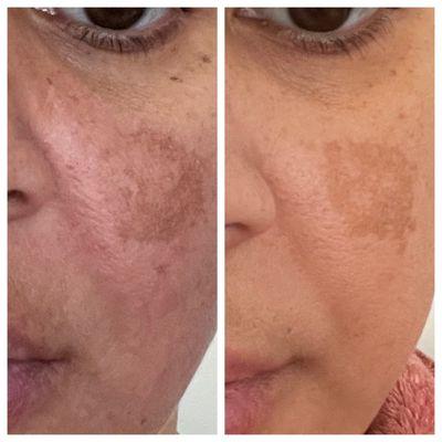 Hyperpigmentation results