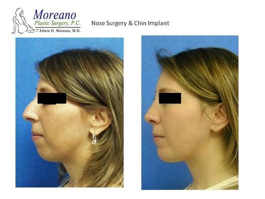 Dr. Moreano performs rhinoplasty completely through the nostrils, eliminating any possibility of scarring, and creating a much better result