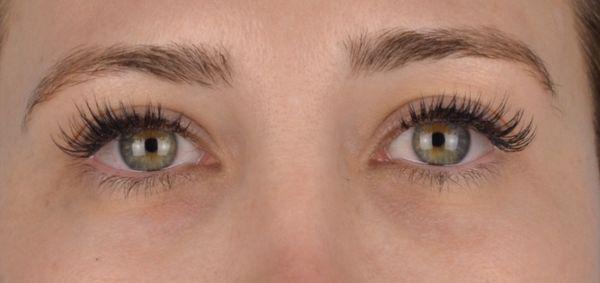 Before Photo (taken at another doctor's consultation) - dark, hollow under eyes