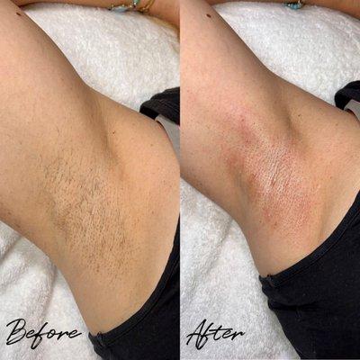 Underarm Sugar Wax Before & After