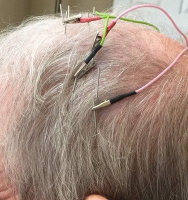 Scalp acupuncture for hemiplegia from a stroke