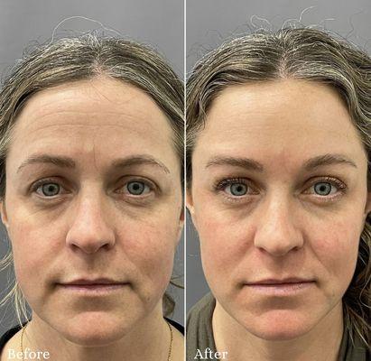 Botox and Restylane filler.