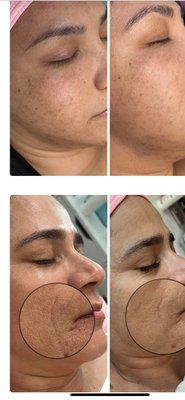 Acne & laugh line reduction from Vivace RF Microneedling