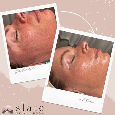 Before and After Results with the Slate Rejuvenation Facial