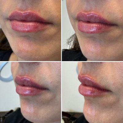 Lip Filler