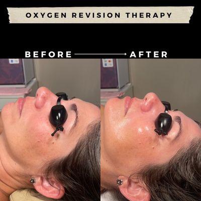 Oxygen revision therapy