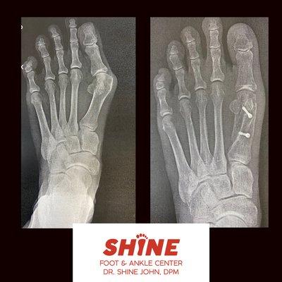 Bunion Correction X-Rays Before and After. Weight bearing is allowed after surgery with no need for a Cast.