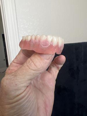 Defective denture.