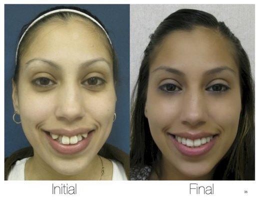 Severe crowding - Before / After Invisalign Teen