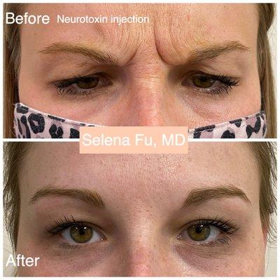 Neurotoxin, such as Botox Dysport Xeomin Jeuveau before and after