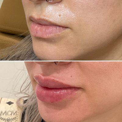 Lip filler - fuller and natural lip enhancement.