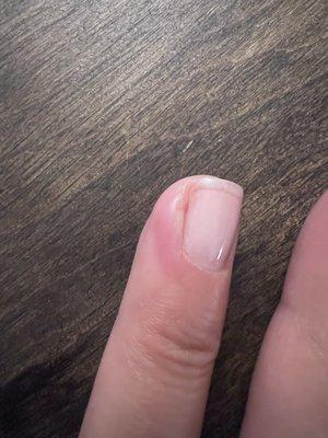 Infection from shellac manicure