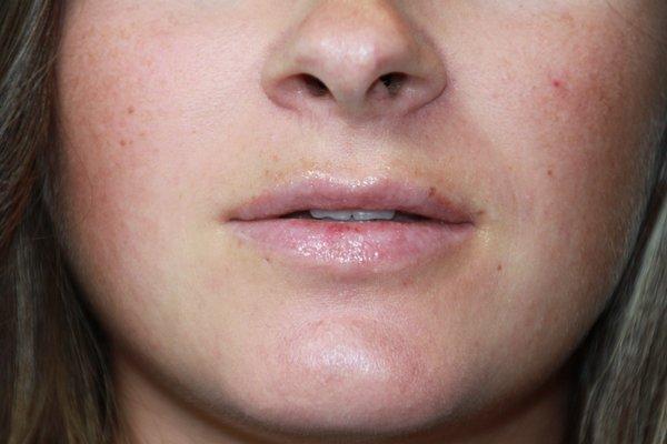 requesting fuller lips.  before 1 syringe of juvederm ultra.