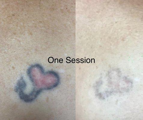 Tattoo removal one session