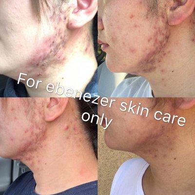 Acne care