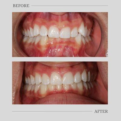 So excited for our patient and his incredible results from SureSmile clear aligners!