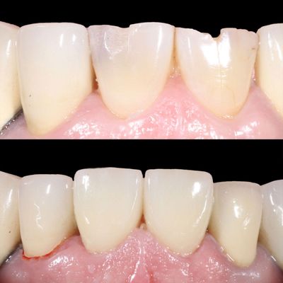 Dental Bonding Midtown Manhattan | Before After