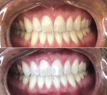 My teeth before and after.