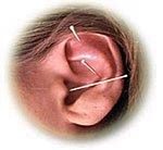 Auricular acupuncture helps reduce appetite & cravings and helps with anxiety, PTSD and more