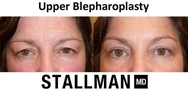 Upper Blepharoplasty, is a procedure to remove skin and/or remove fat from the eyelids.