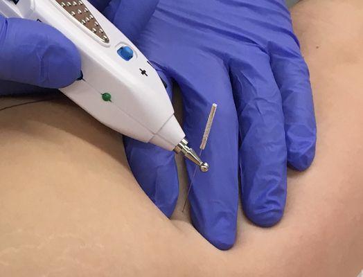 Dry Needling Trigger Point Muscle Therapy with Electrical Muscle Stimulation (EMS).