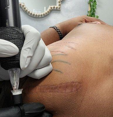 Scar lighten with tattooing.