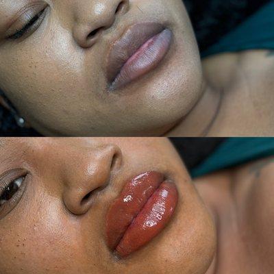 Lip neutralization