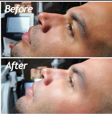 Rhinoplasty with dermal fillers