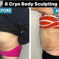 Cryo Body Sculpting Results