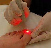 Nail Fungal Removal