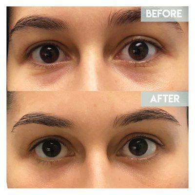 Fillers under the eyes