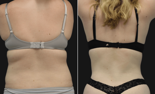 24-year-old patient: Before and after lipo of abdomen, back, and flanks with Dr. Maia, renowned for body contouring in Tysons Corner, VA.