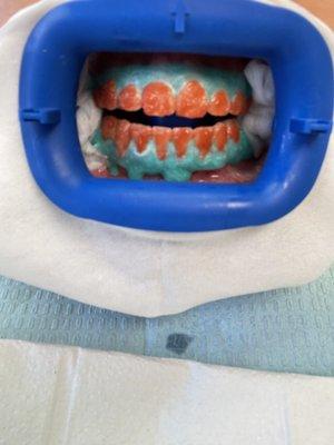 Teeth Bleaching