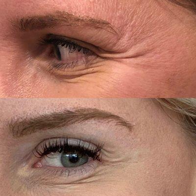 Botox Before & After Crows Feet