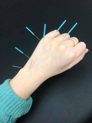 Acupuncture for a hand injury.