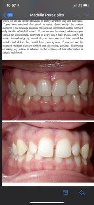 Before and after Invisalign/ bonding