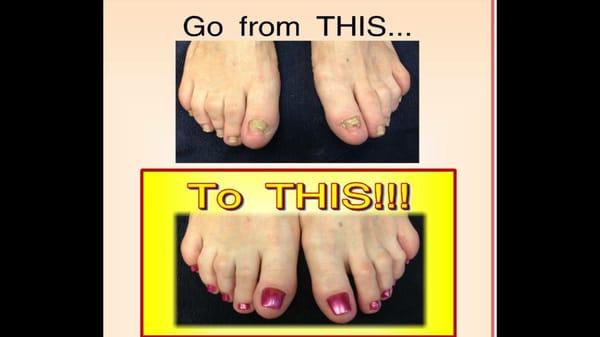 Dont be afraid of wearing those sandals ever again..... The magic of acrylic could change your life! Acrylic Nails are the bomb!