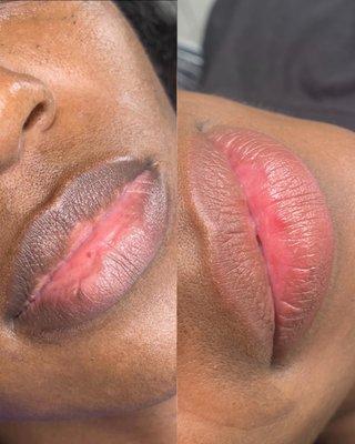 Lip Neutralization by Holly - Before (left) and Healed After (right)