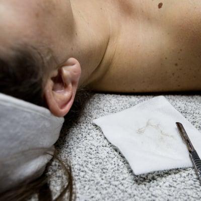 dermaplaning