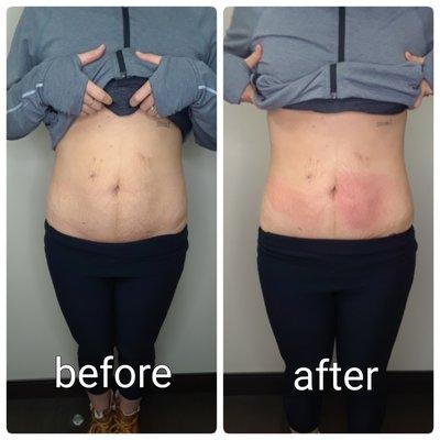 Cryoskin Slimming treatments freeze fat cells in target areas and allow the body's natural processes to flush the dead cells out permanently