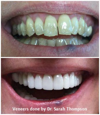 Actual patient of Cosmetic Dentist Sarah Thompson.  Patient received several veneers.