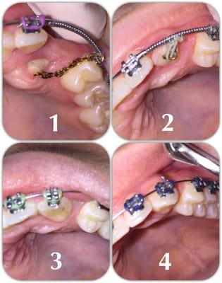 Impacted canine correction