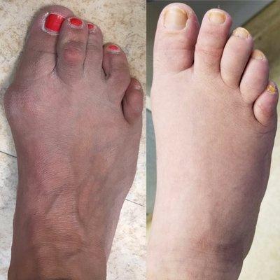 Minimally Invasive Scarless Bunionectomy and Hammertoe Correction - Before and After (walking in regular shoes after just 4 weeks!)