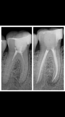 Re-treating a incomplete root canal