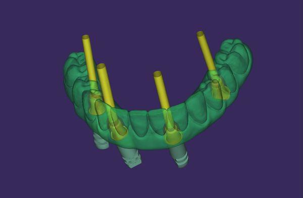 Digital Implant Design of a lower arch before milling.